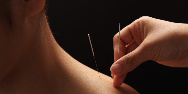 Dry Needling.